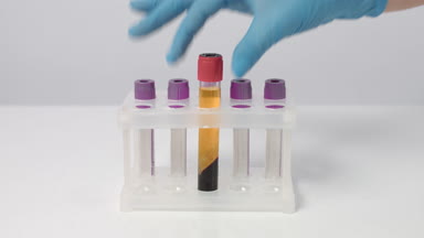 Putting two test tubes with centrifuged blood plasma in rack