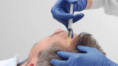 Close-up of platelet-rich plasma injections for hair regrowth