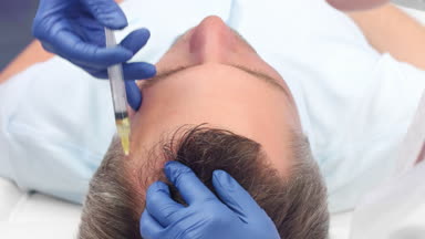 Close-up shot of hair restoration prp injections
