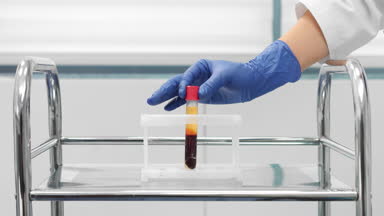 Vacuum blood sample tube with separated blood sample.